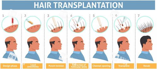 头发种植流程图一览 头发种植流程图一览