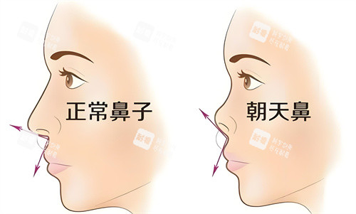 正常鼻子与朝天鼻对比动画图 正常鼻子与朝天鼻对比动画图