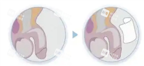 阴茎生物补片手术过程介绍 阴茎生物补片手术过程介绍