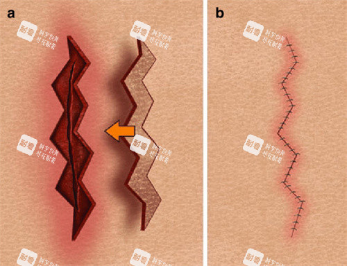 疤痕修复缝合