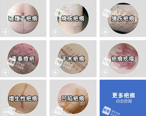 哪些疤痕需要祛除改善