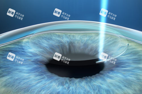 近视手术示意图 近视手术示意图