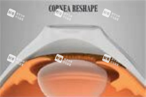 角膜塑形镜3副本 角膜塑形镜3副本