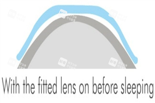 2角膜塑形镜 2角膜塑形镜