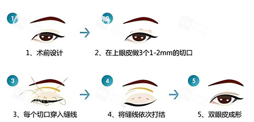 双眼皮三点术过程原理 双眼皮三点术过程原理