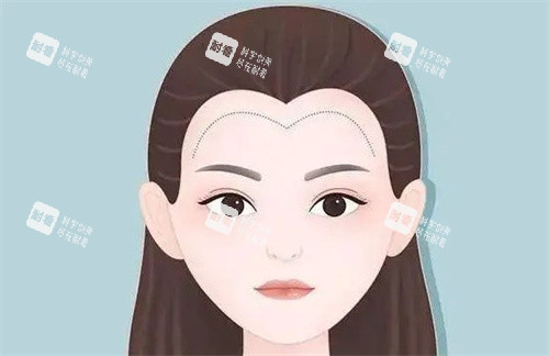 植发际线卡通 植发际线卡通