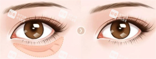 去眼袋手术前后 去眼袋手术前后