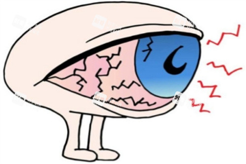 干眼症卡通图 干眼症卡通图