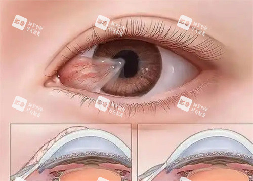 眼球结膜松弛卡通图