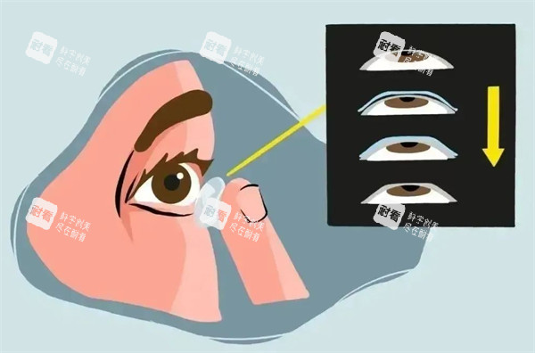 离焦软镜佩戴前后眼球的变化图解