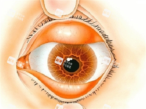 眼球结膜松弛卡通细节图 眼球结膜松弛卡通细节图