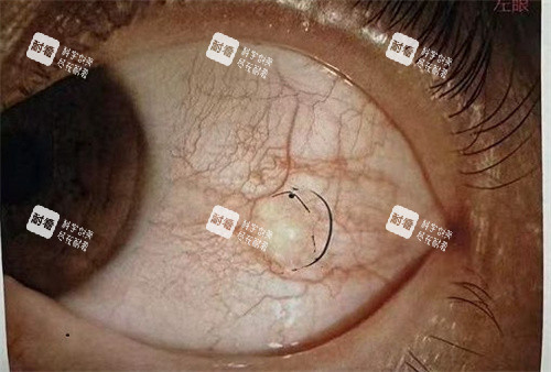 眼球结膜松弛的症状 眼球结膜松弛的症状