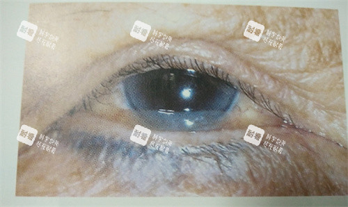 眼球结膜松弛 眼球结膜松弛