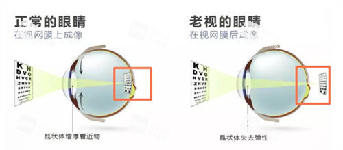 老花眼 老花眼