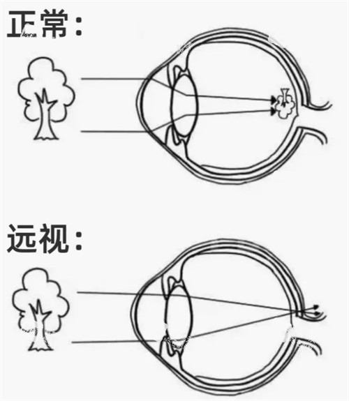 正常眼镜和远视眼睛