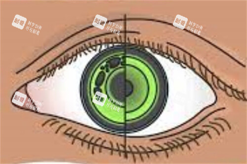 佩戴角膜塑形镜眼睛示意图