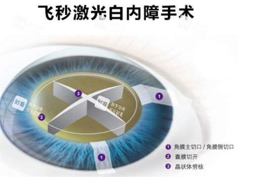 飞秒激光白内障手术