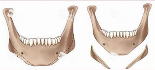 削骨前后示意图