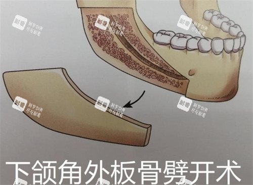下颌角外板劈开术 下颌角外板劈开术