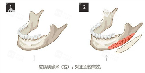 下颌角削骨 下颌角削骨