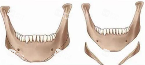 下颌角削骨前后对比 下颌角削骨前后对比