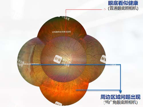 超广角眼底照相机对比普通眼底相机眼底差别漫画图 超广角眼底照相机对比普通眼底相机眼底差别漫画图