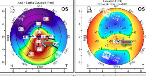 眼底检查图 眼底检查图