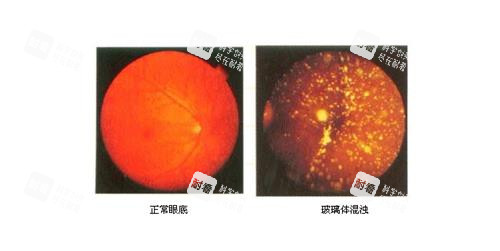 玻璃体浑浊和正常眼底的对比 玻璃体浑浊和正常眼底的对比
