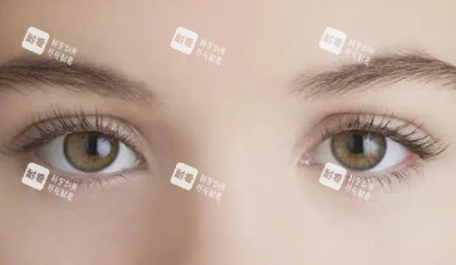 开眼角手术.webp