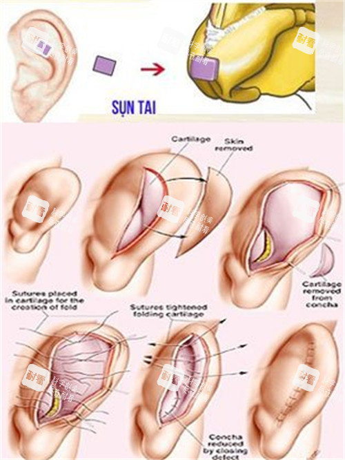 耳软骨隆鼻 耳软骨隆鼻