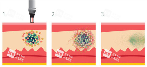 蜂巢皮秒祛斑 蜂巢皮秒祛斑