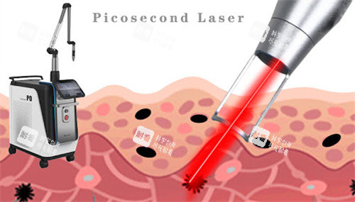 蜂巢皮秒作用图 蜂巢皮秒作用图