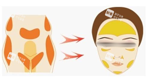 自体脂肪面部填充示意图