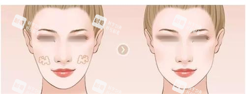 面部填充对比图