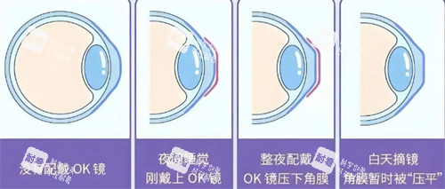 角膜塑形镜佩戴前后对比图
