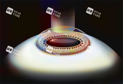 smart激光近视手术演示