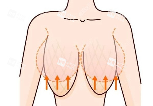 缩胸形态示意图