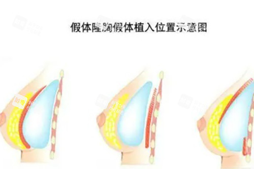 假体隆胸示意图