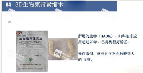 3d生物束带紧缩术材料讲解