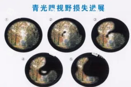 青光眼视野损失进展展示图