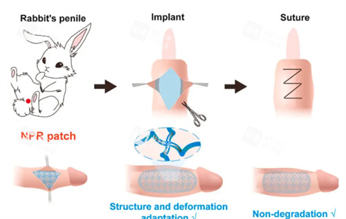 阴茎生物补片演示过程
