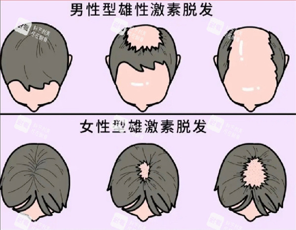 脱发图片