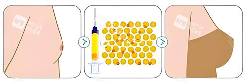 自体脂肪隆胸对比