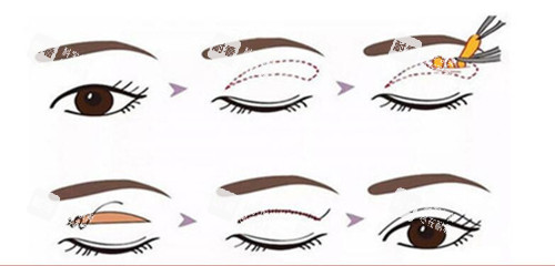 全切双眼皮过程示意图