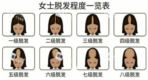 脱发等级 脱发等级