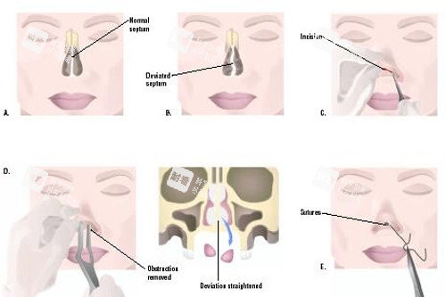 鼻再造手术的过程图解