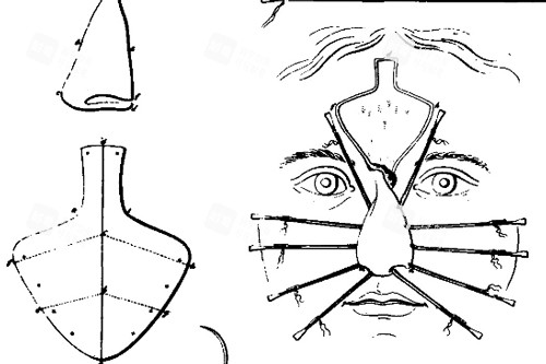 鼻再造手术部位