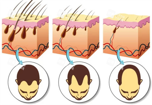 不同程度脱发的对比图解 不同程度脱发的对比图解