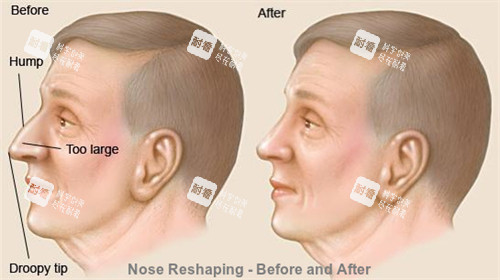 正常鼻子和过长的鼻子矫正对比 正常鼻子和过长的鼻子矫正对比