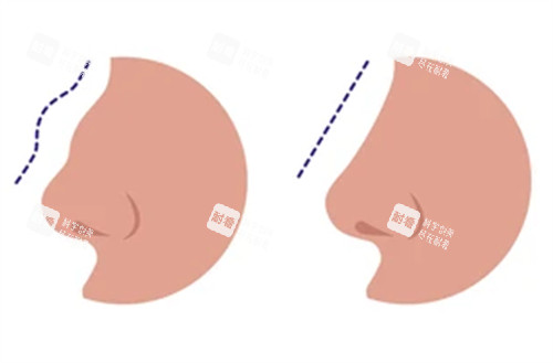 修复失败鼻子前后对比图
